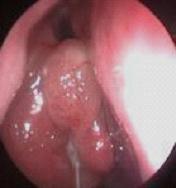 原医生分析:慢性鼻炎类型?症状区分?